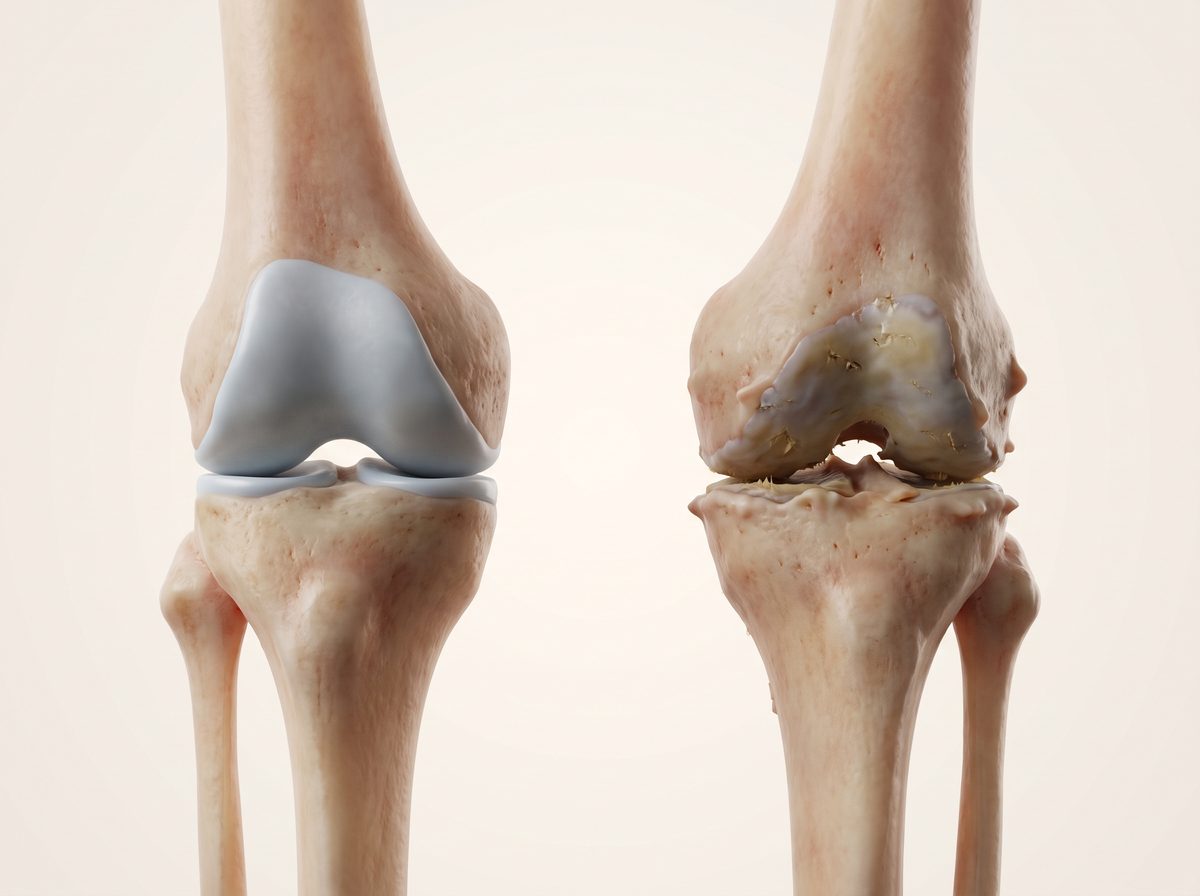 Ilustración de una rodilla sana junto a otra con artrosis