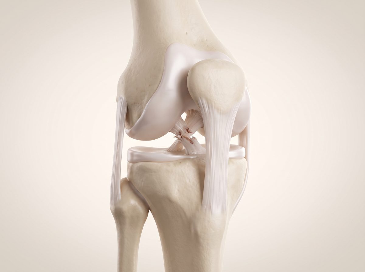 Ilustración de una rodilla con el ligamento cruzado anterior roto
